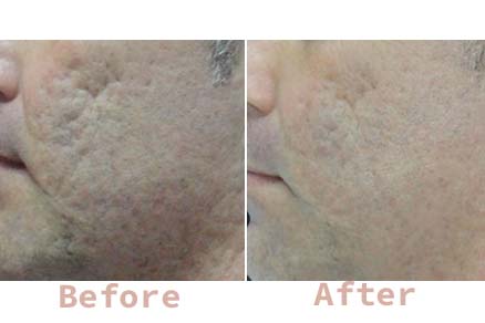 acne scar treatment abu dhabi
