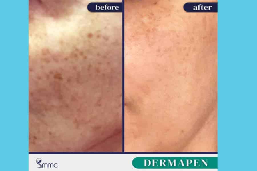 DERMA PEN Treatments