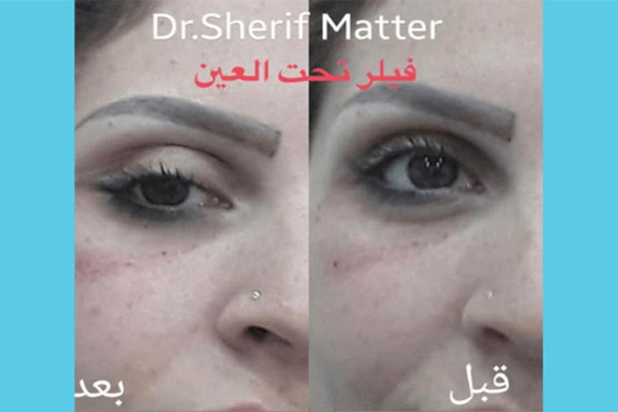 Filler Treatment In Abu Dhabi