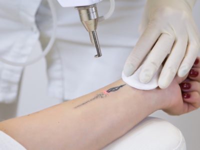 10 Biggest Misconceptions About Tattoo Removal