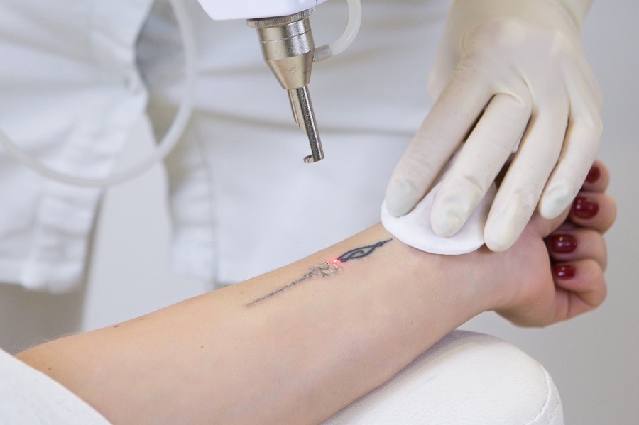 10 Biggest Misconceptions About Tattoo Removal | Drsmmc