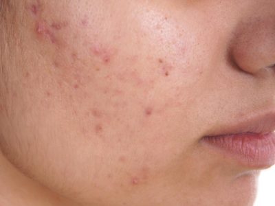 Can Acne be treated and how can we get rid of its marks?
